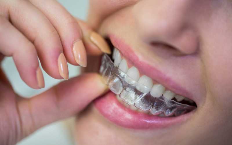 Tratamentos estéticos dentais que você precisa conhecer