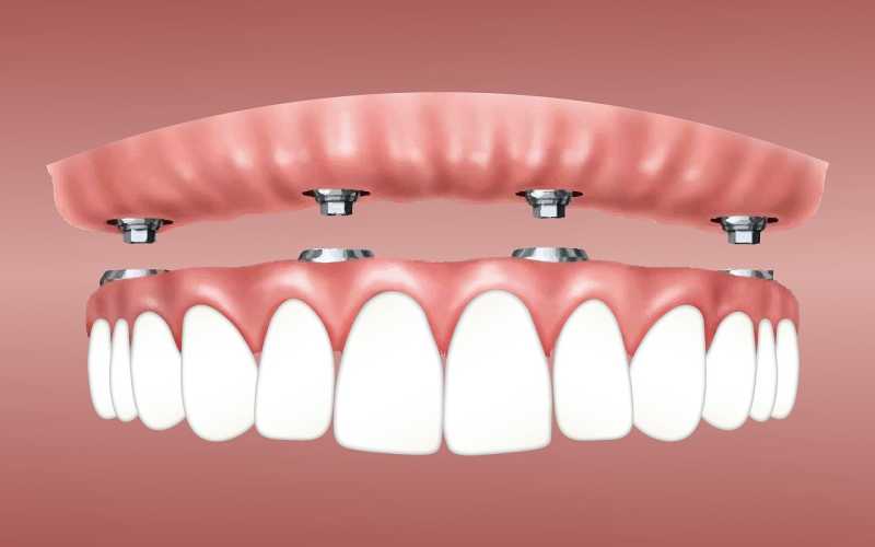 Quais as etapas de um implante dentário