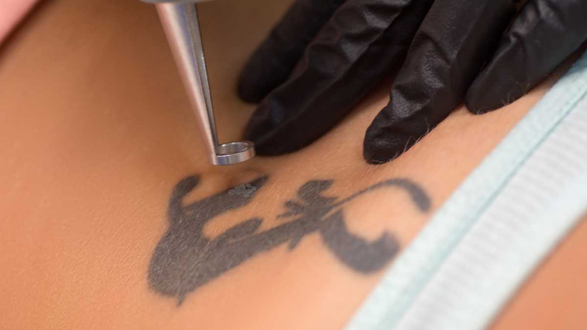Alternativas para desfazer tatuagens